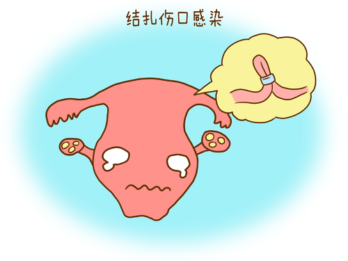 輸卵管積水做試管治療，需要結扎嗎？