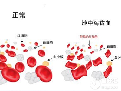 地中海貧血會(huì)遺傳嗎？第三代試管技術(shù)怎么避免？