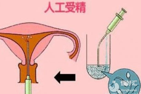 上海人工授精費用講解，這4大因素影響最終價格！