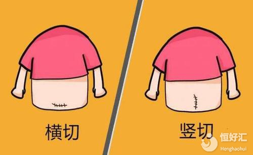 剖腹產(chǎn)橫切PK豎切：到底選擇哪個更好？