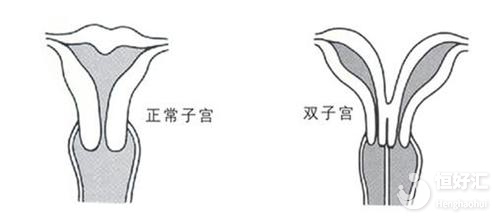 注意！子宮畸形正危及你的 “好孕”?！
