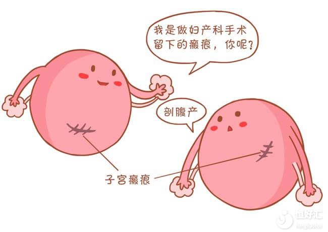 瘢痕子宮是什么？能做試管嬰兒嗎？